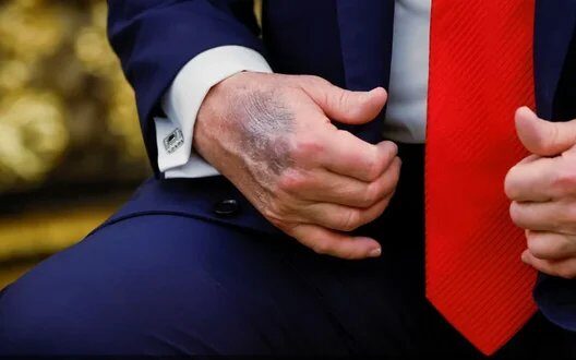 Trump Health Meaning Of Plasters And Bruises On Hands